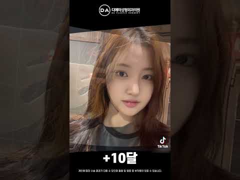 미니리프팅+코성형