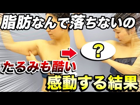 たるんだ二の腕がここまで変わる！脂肪吸引と糸リフトの3ヶ月後を公開【二の腕痩せ】