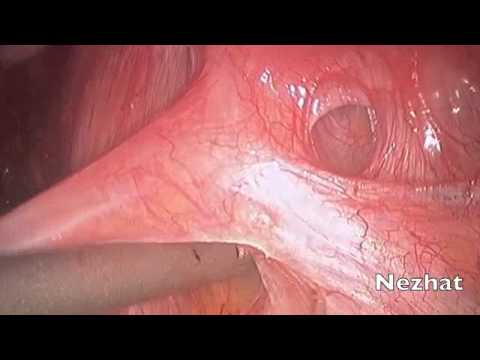 Endometriose: laparoskopische vordere Rektumresektion 