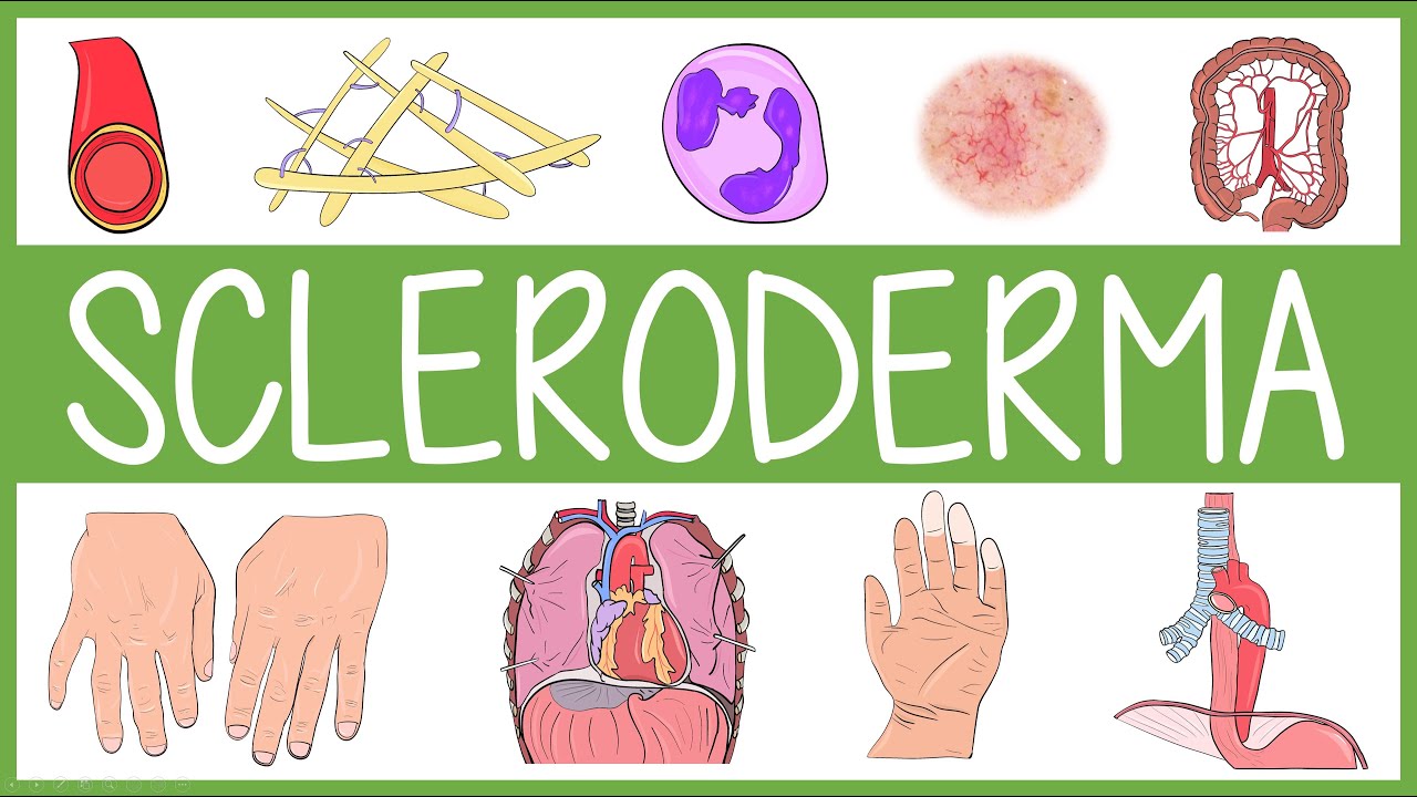 Scleroderma