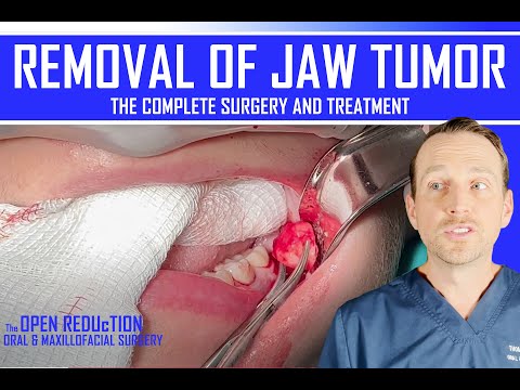 Removal Of a Jaw Tumor | White Spot On X-ray - Part 2 