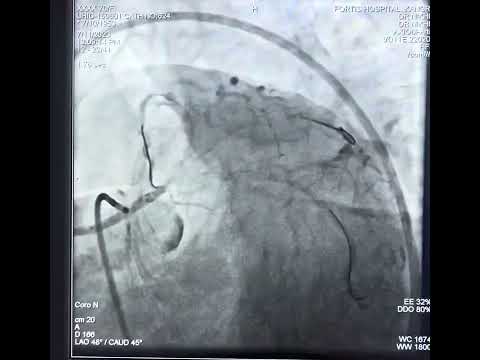 Left main Trifurcation stenting under Ivus guidance with RCA CTO and EF 35%