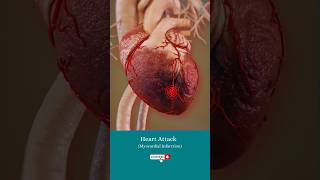Download lagu What happens during a heart attack? ↪ 3D Medical Animation #Shorts #HeartAttack #Heart #Health mp3