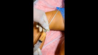 ADIPOSIDAD LOCALIZADA EN RODILLAS MINI LIPOSUCCION ES TU SOLUCIÓN