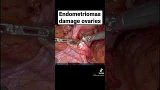 Endometrioma damages ovary
