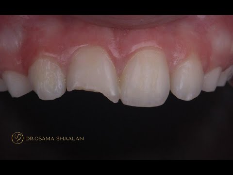 Using Lm arte dark diamond kit - class IV restoration