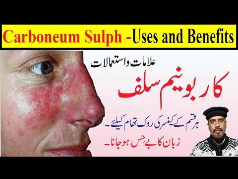Carboneum Sulph 30, 200, 1M homeopathic medicine uses in Hindi |Lupus on face |Stop Cancer to spread