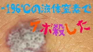 俺のイボがぁ~