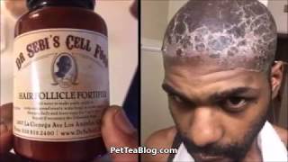 Dr Sebi team RESPONDS to Hair Follicle Product that BURNED Mans Scalp 👀😱💀 FINALLY!