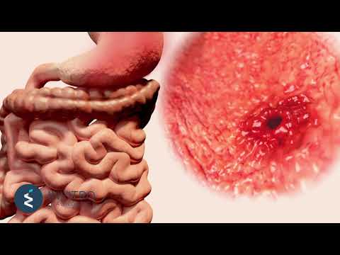 Ce este Helicobacter Pylori? Ne vorbește medicul Procopciuc Ecaterina