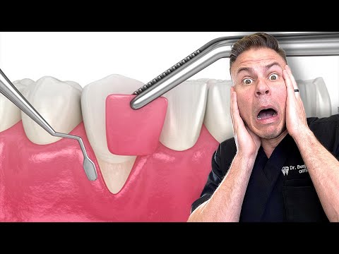 Dentist Reveals What REALLY Happens In A Gum Graft!