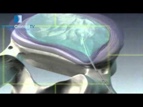 In che aveva unosteocondrosi cervicale con mal di testa Giunto nella zona della caviglia