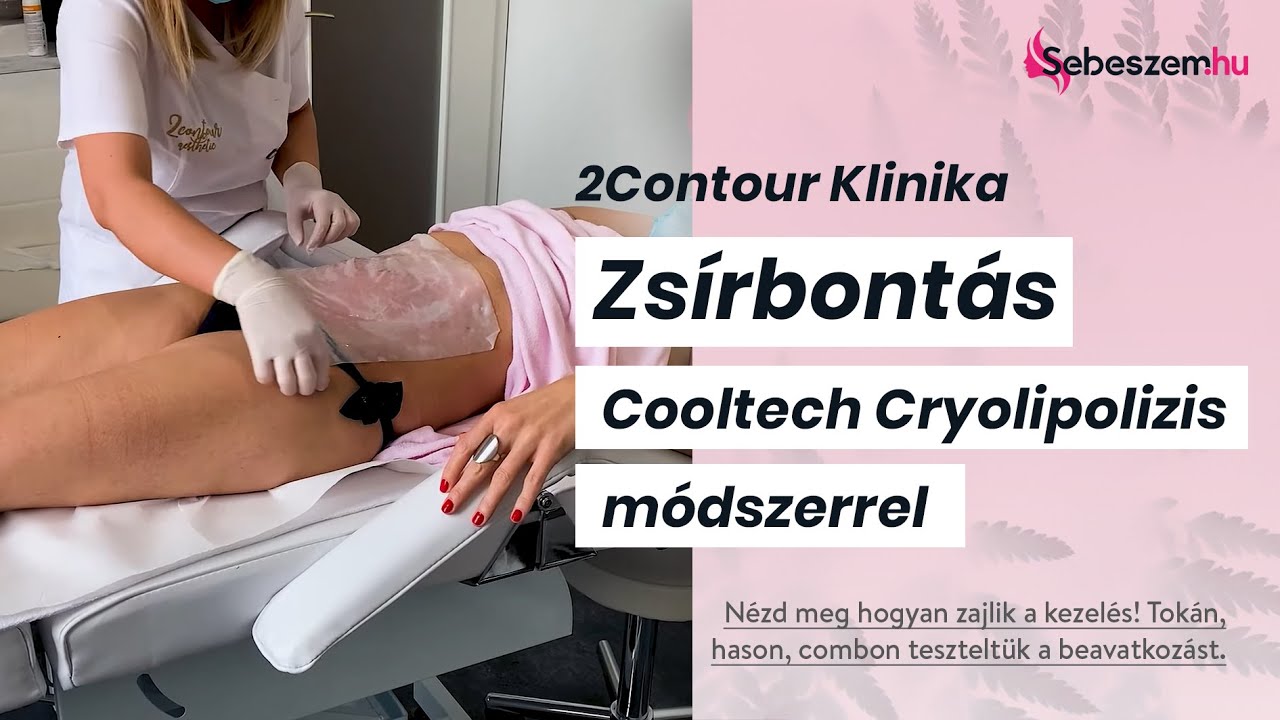 Cooltech zsírfagyasztásos eljárás