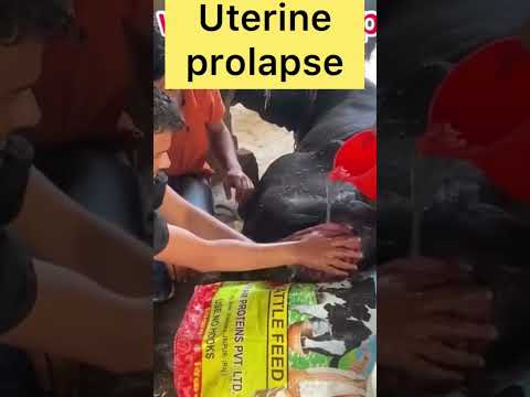 , title : 'Uterine prolapse l dr umar khan'