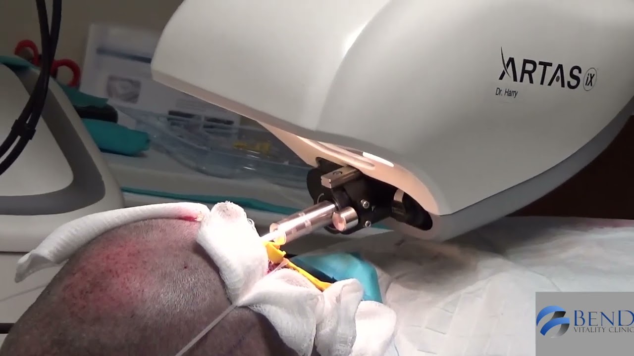 Dr. Andy Higgins and the ARTAS iX RoboticHair Transplantation Procedure
