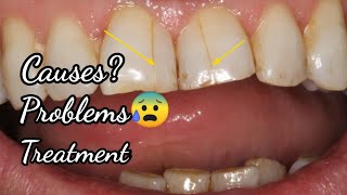 दाँतो में दरारे होने के कारण और इलाज ! #Crazelines causes , appearance & treatment