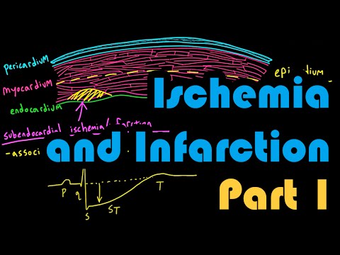 Ischemia, Infarction, and the Waveforms Q through U, Part 1: How to Read an EKG Curriculum