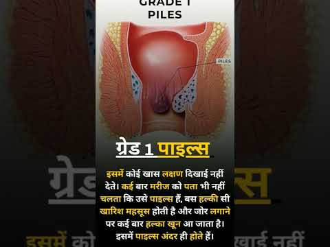 About Grade 1 Piles #shorts #youtube #youtubeshorts #piles
