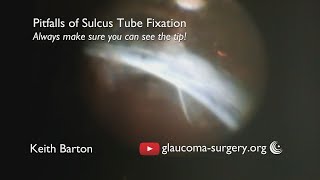 The pitfalls of sulcus tube fixation. What can go wrong if you can't see the tip.