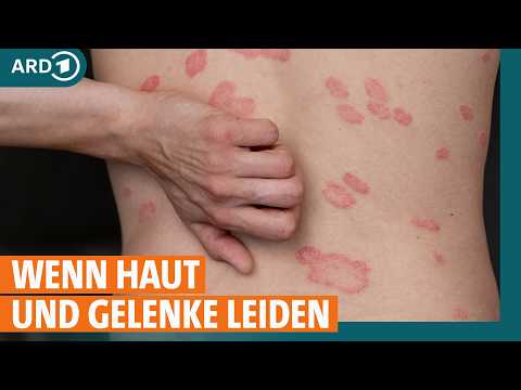 Schuppenflechte behandeln: Ursachen und was hilft bei Psoriasis? I ARD Gesund