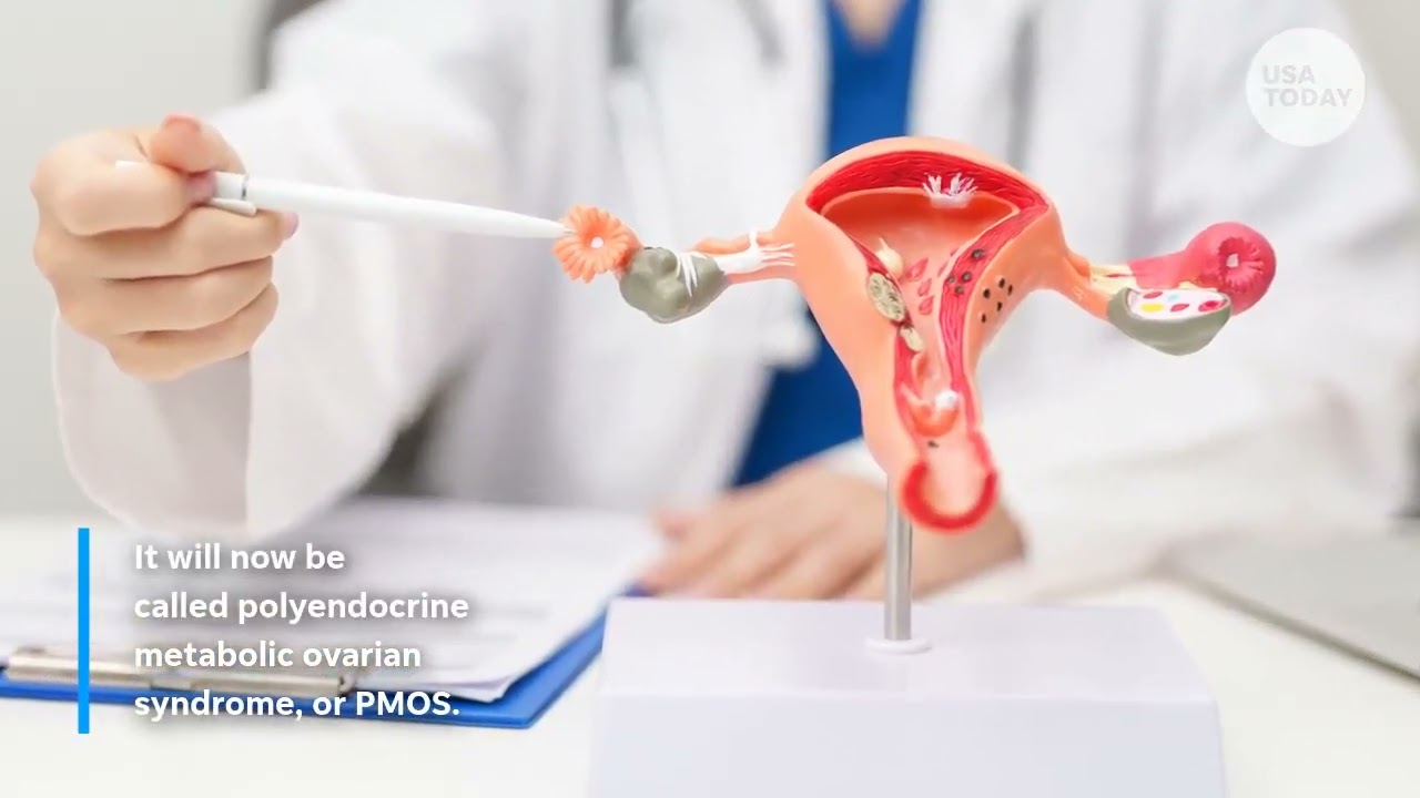 PCOS gets new name to reflect full hormonal and metabolic impact