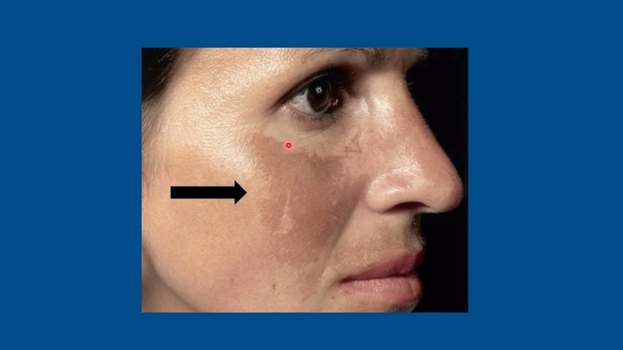 Melasma ppt for Medical Students