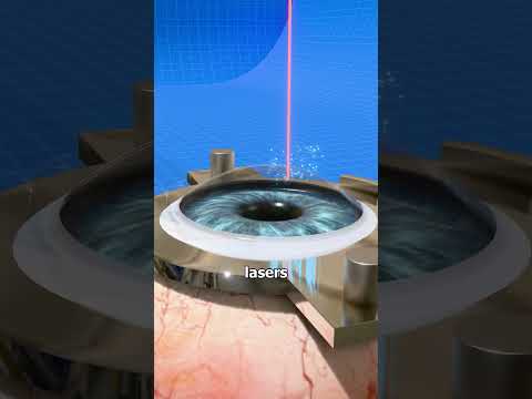 How Laser Eye Surgery Actually Works! 👁️‍🗨️