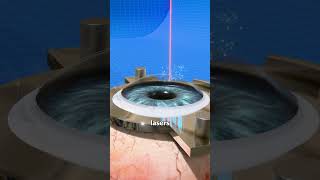 How Laser Eye Surgery Actually Works! 👁️‍🗨️