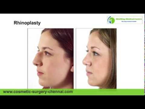 Nose Surgery Chennai | Rhinoplasty Cost India