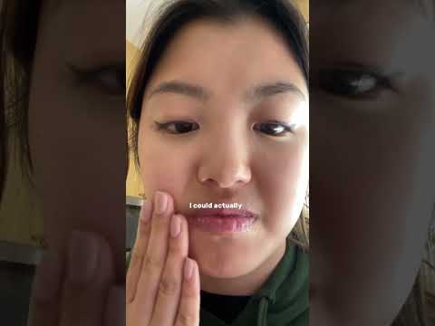 everything I ate after wisdom teeth surgery