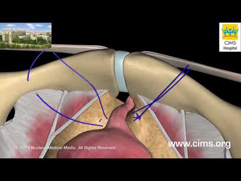 Stress Urinary Incontinence - CIMS Hospital