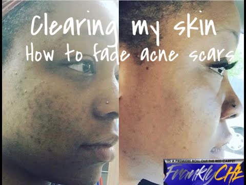 SKINCARE ROUTINE How I’m clearing my acne and dark scars