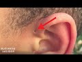 Explaining A Preauricular Sinus,  A Tiny Hole Above Some People's Ears
