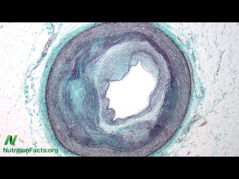 Childhood Constipation and Cow s Milk