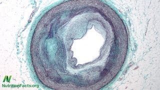 Heart Disease Starts in Childhood