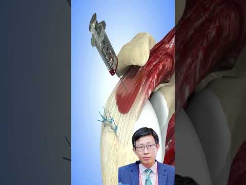 Healing Shoulders: BMAC vs BMAC+PRP in Rotator Cuff Repair 회전근개 치료: BMAC 단독과 BMAC+PRP 병용의 효과 비교
