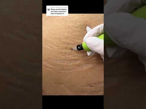 Stretch Marks Inkless Removal Boleyn Treatment Los Angeles  🌍 #shorts