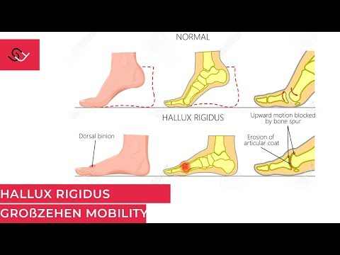 Hallux Rigidus - Osteoarthritis of the metatarsophalangeal joint - Helpful exercises