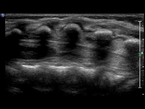 Spinal US - blunt cord terminus