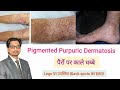 Pigmented Purpuric Dermatosis | PPD | पैरों पर काले धब्बे | Legs पर उपस्थ