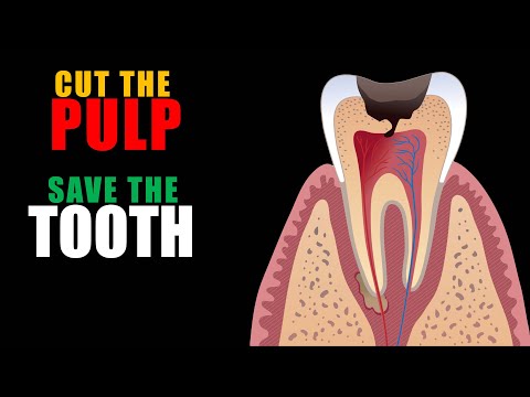 Pulpotomia w zębie stałym