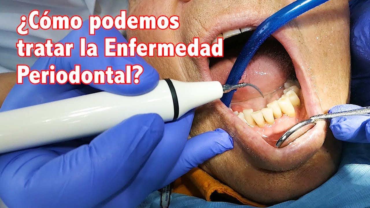 Enfermedad Periodontal II. ¿Cómo podemos tratar la enfermedad periodontal