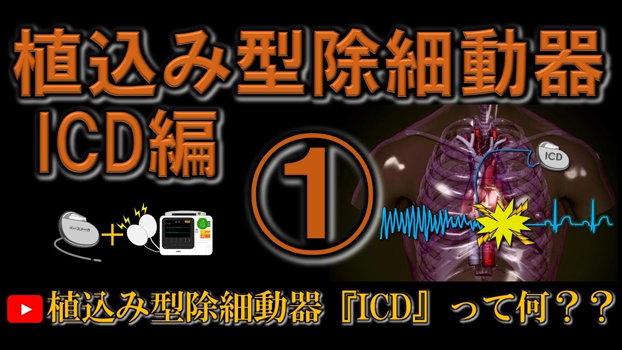イラストで分かるICD①植込み型除細動器ICDって何？？
