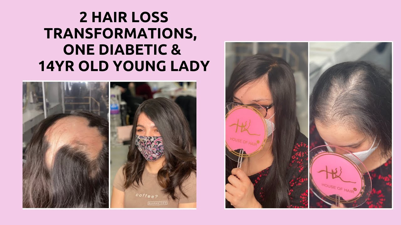 Female hairloss Transformation (FEMALE HAIR LOSS SYSTEMS)