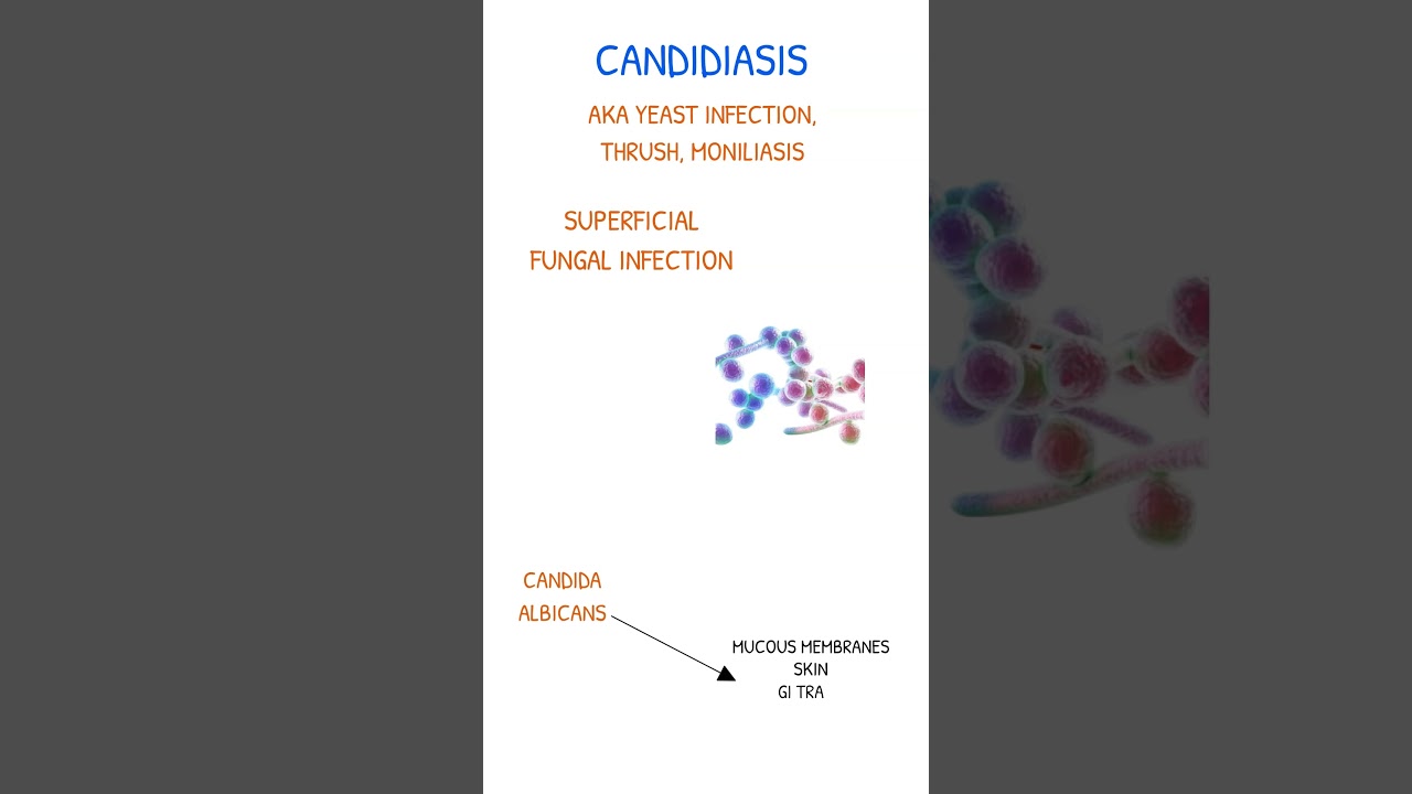 CANDIDIASIS