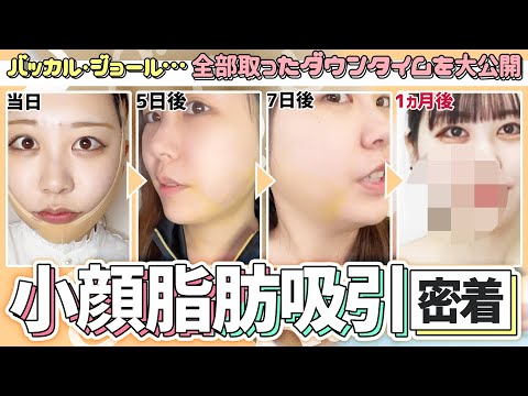 【ダウンタイム】糸リフトや脂肪吸引など…小顔整形を受けた20代女性の経過に密着！【大阪TAクリニック】