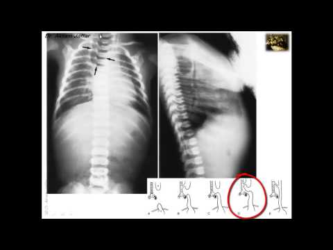 Embryology Of Congenital Anomalies Of The Foregut 1