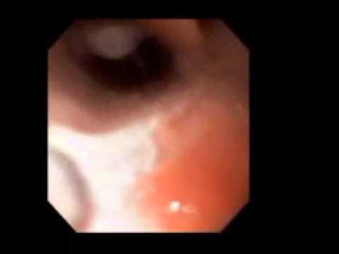 Vocal Cord View