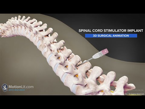 3D Surgery Animation of Spine Injury Portrays Spinal Cord Stimulator Implant
