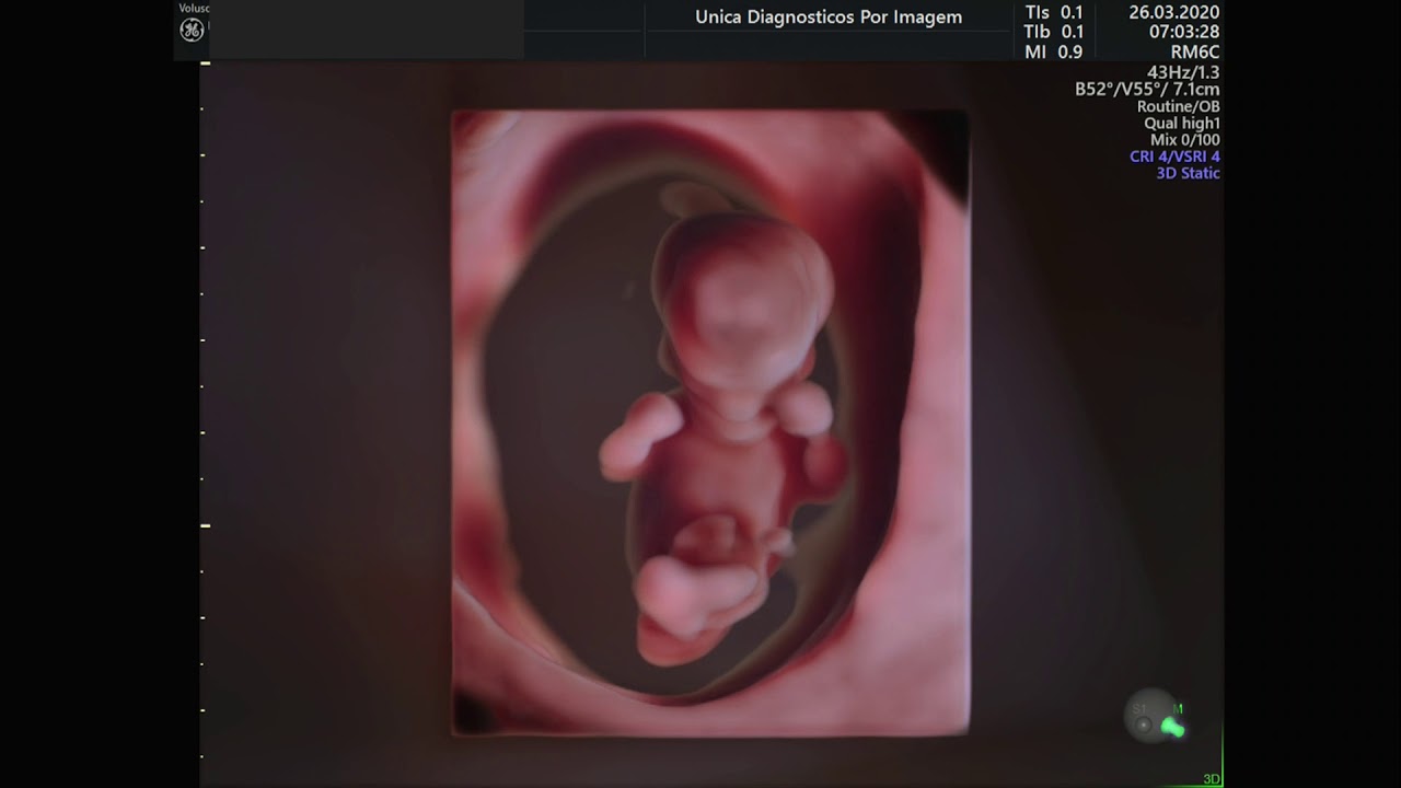Ultrassom 4D em feto 11 de semanas
